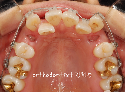 강남 덧니 관련 이미지 18