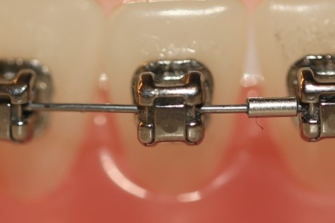 세라믹교정 세라믹치과 - 일상중에도 편안하게 교정한다 관련 이미지 3