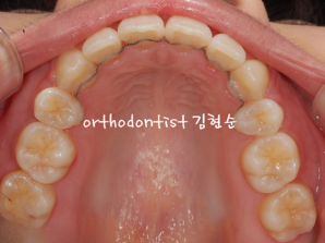 강남 돌출입 교정 관련 이미지 20