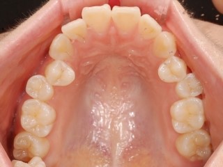 3D 스캐너를 이용한 교정 심뮬레이션 관련 이미지 9