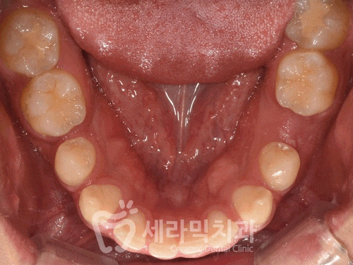 과개교합, 거미스마일, 치아 벌어짐까지 한번에! 치아교정전후 살펴보기 관련 이미지 5