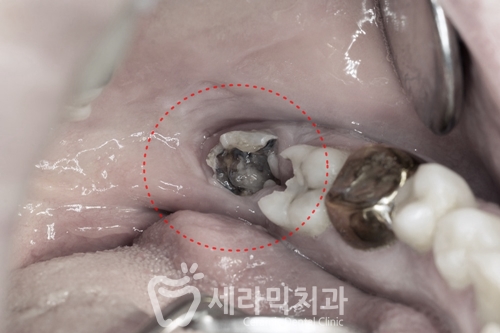 돌출입교정으로 갸름한 턱라인까지 되찾다! 돌출입 치아교정전후 관련 이미지 2