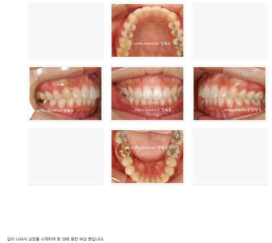 세라믹교정 세라믹치과-돌출입발치교정 7 관련 이미지 2