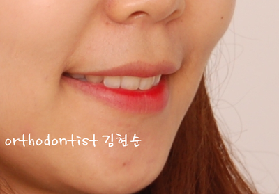 강남 돌출 관련 이미지 29