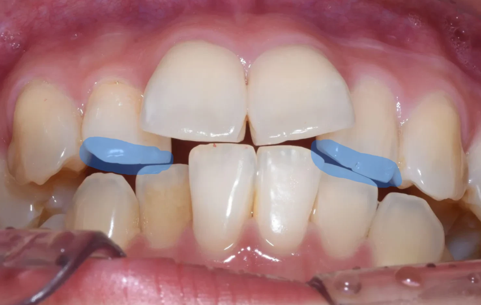 세라믹 치과, 삐뚤빼뚤한 치아를 교정 없이 라미네이트로 치료한 사례 관련 이미지 4