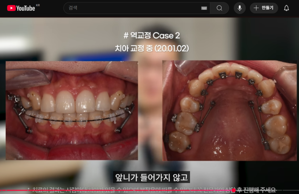 '옥니 역교정' 의미, 치료법, 부작용 알아보기 (+교정치과 선택 Tip) 관련 이미지 5