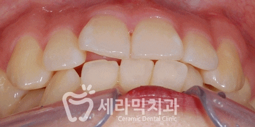 돌출입과 과개교합, 중심선 불일치, 치열불규칙 치아교정전후사진 관련 이미지 7