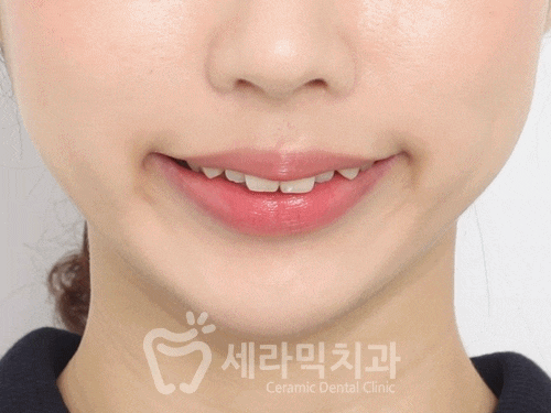 앞니 돌출, 개방교합으로 치아교정을 시작했는데, 작았던 아래턱이 커졌어요! 관련 이미지 2