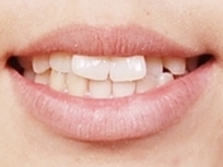 학동역 치아교정, 수술없이 예뻐져도 되나요? [돌출입교정 전후 달라진 외모] 관련 이미지 5