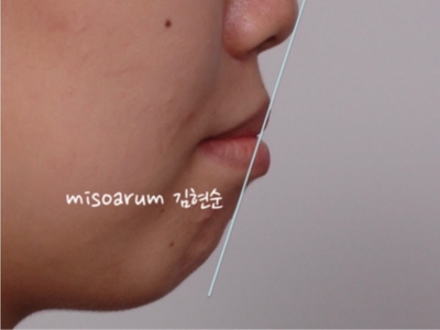 강남치아교정추천 관련 이미지 9