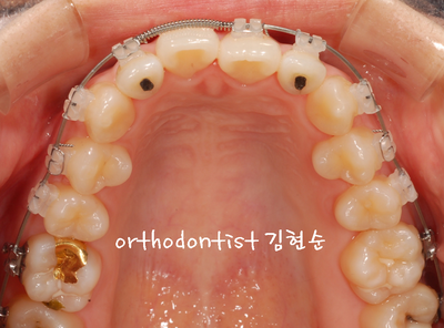 개방 교합 관련 이미지 17