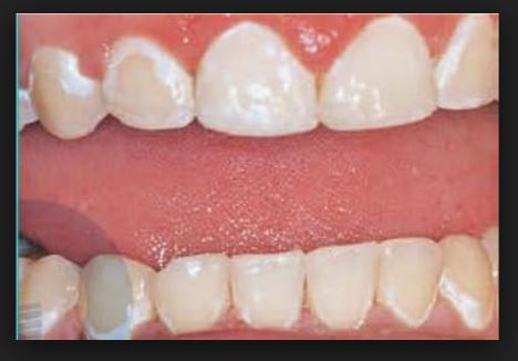 치아교정 부작용 탈회와 치아우식 관련 이미지 1