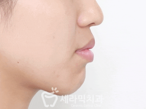 돌출입과 개방교합, 치아교정전후 자신감 UP! 치아건강 UP! 관련 이미지 5