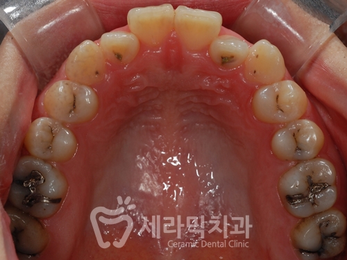 앞니 돌출, 개방교합으로 치아교정을 시작했는데, 작았던 아래턱이 커졌어요! 관련 이미지 9