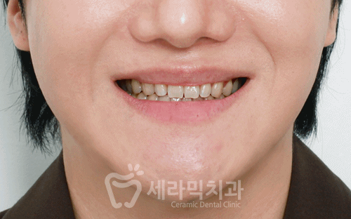 강남라미네이트치과 세라네이트 전후 사례 - 달라진 스마일라인 관련 이미지 6