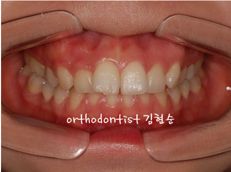 강남 돌출입 교정 관련 이미지 30