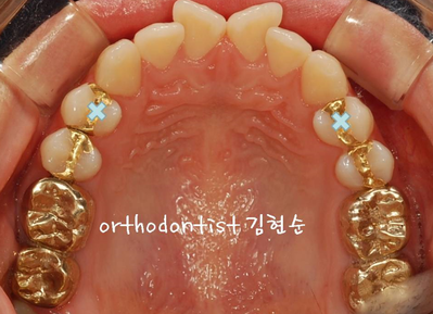 강남 돌출입 교정 관련 이미지 7