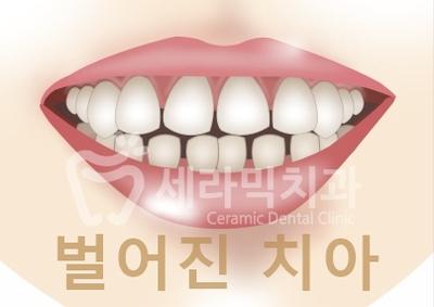 벌어진 앞니, 치아 사이 공간 교정 잘하는 세라믹치과 관련 이미지 1