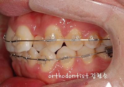 반대교합 관련 이미지 17