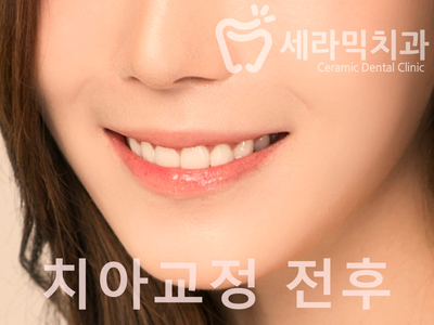 치아교정 전후 확연한 인상 변화! 관련 이미지 1