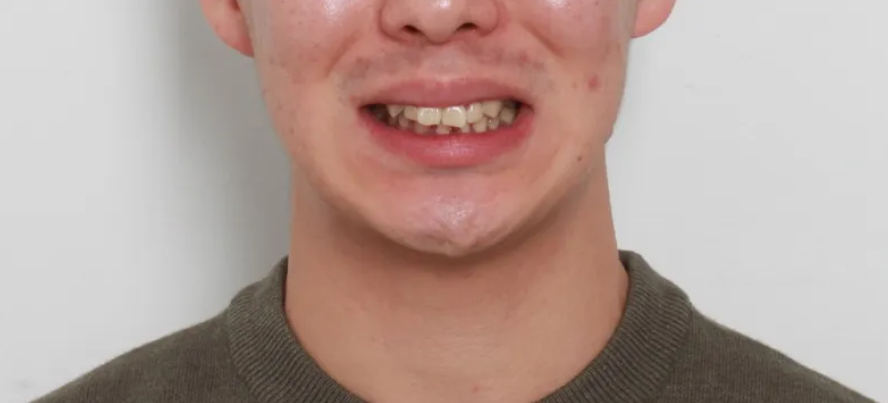 결손치를 임플란트 없이 교정으로 치료한 사례 관련 이미지 5