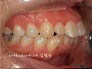 강남 돌출입 교정 관련 이미지 24