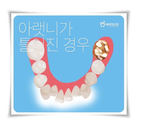 앞니투명교정  6개월이면 ok ! 관련 이미지 4