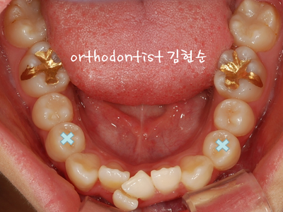 강남 덧니 관련 이미지 11