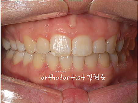 강남 돌출입 교정 관련 이미지 34