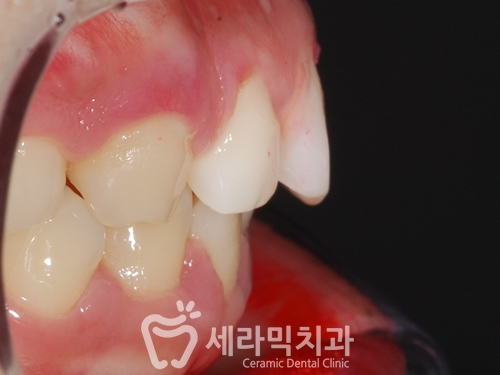 딥바이트 과개교합 치아교정전후 변화 관련 이미지 2