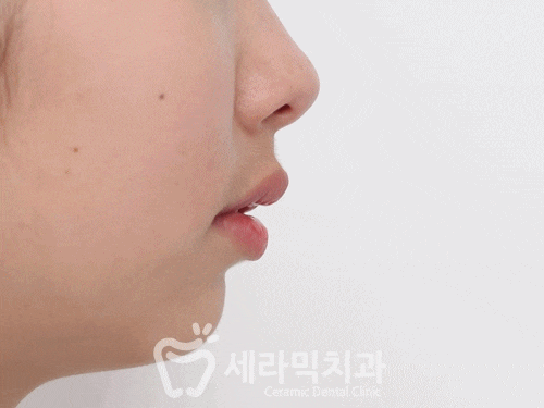 돌출입교정, 심미성과 치아 건강을 동시에 해결! 관련 이미지 1