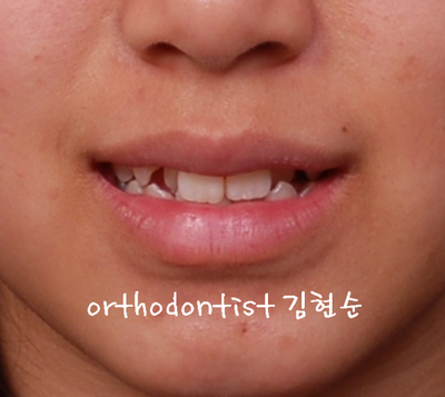 강남 덧니 관련 이미지 7