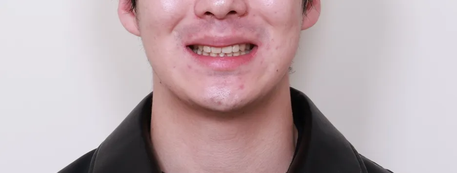 결손치를 임플란트 없이 교정으로 치료한 사례 관련 이미지 12