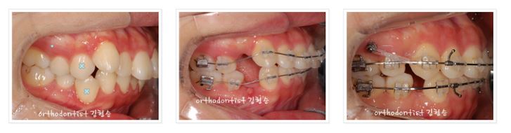 발치교정 부작용 옥니 해결법 관련 이미지 3