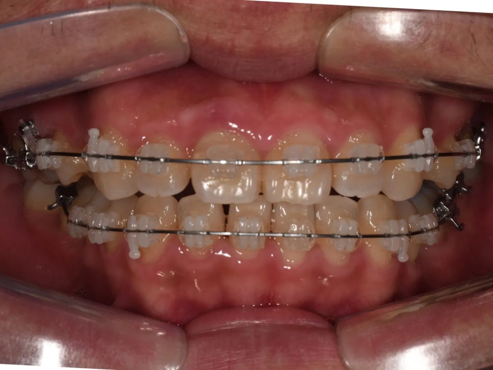 돌출입 교정 전후, 그런데 과개교합까지 있으셨던 환자분 관련 이미지 15