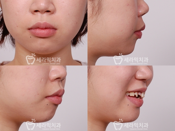 깨진 후에 후회하는 돌출입, 치아교정으로 건강하고 가지런한 치아만들기 관련 이미지 5