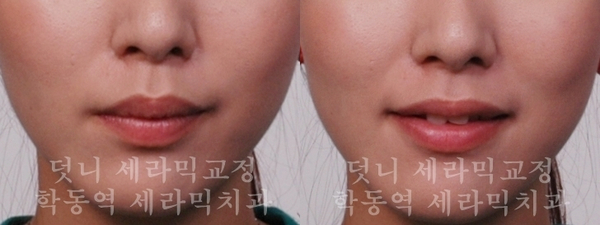 덧니교정 잘하는 학동역 교정치과, 세라믹치과 관련 이미지 5