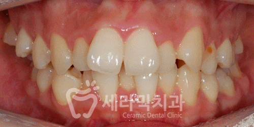 치아교정만으로 세마리 토끼를 한번에! 돌출입, 무턱, 치열불규칙 치아교정전후 관련 이미지 12