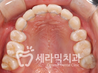 토끼이빨, 틀어진 치아배열 세라믹교정 전후사진 관련 이미지 23