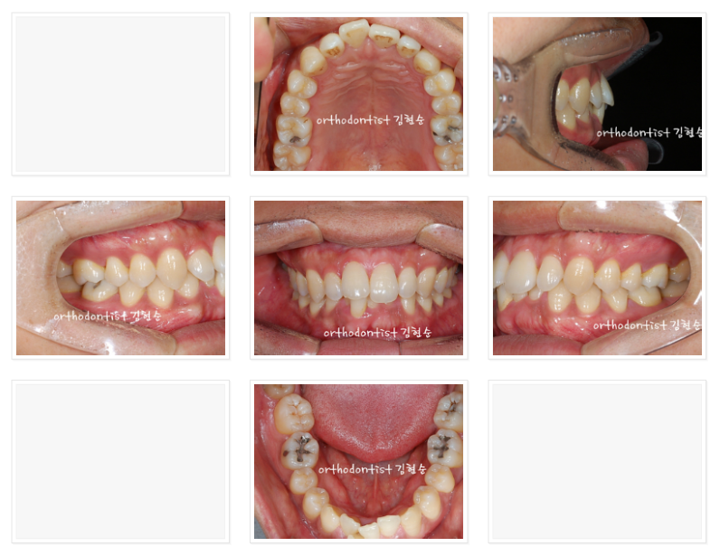 들쑥날쑥한 아래 앞니, 발치 후 교정 관련 이미지 2