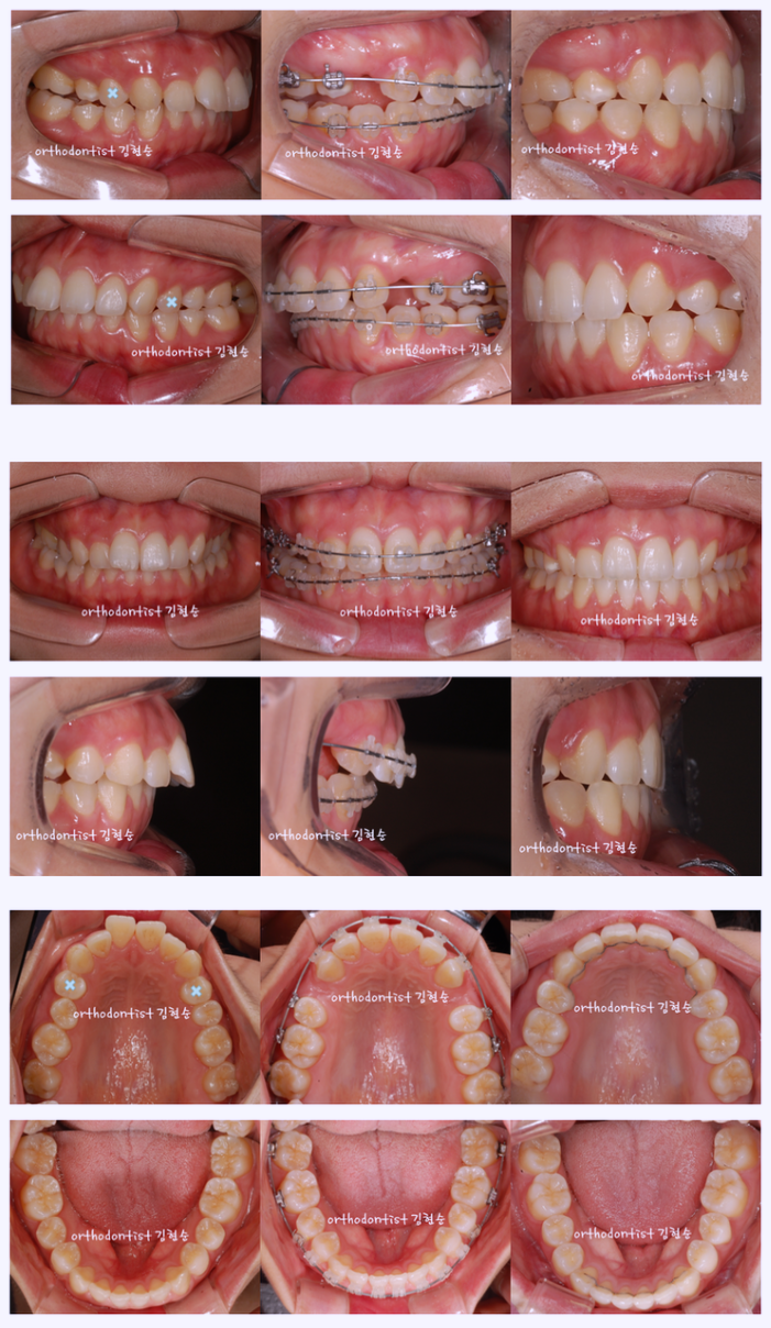 강남 돌출입 관련 이미지 6