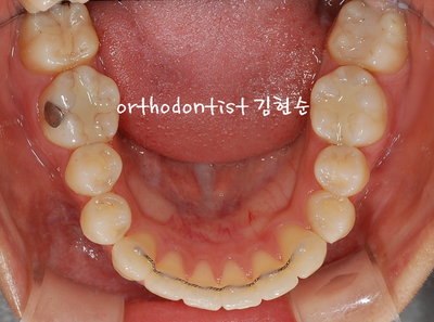 강남 돌출 관련 이미지 24