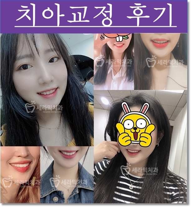 삐뚤빼뚤 틀어지고 불규칙한 치아배열 치아교정전후 관련 이미지 7