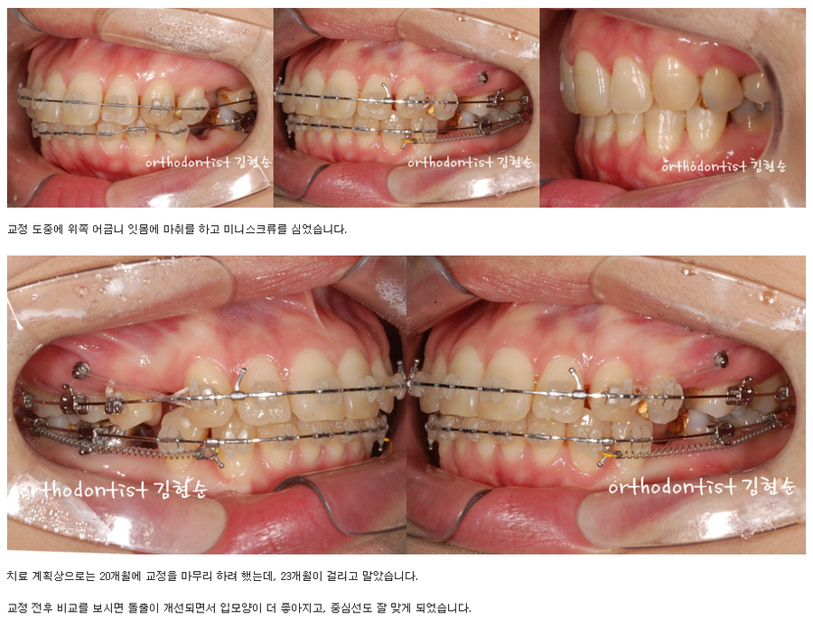 세라믹교정 세라믹치과-돌출입발치교정 10 관련 이미지 6