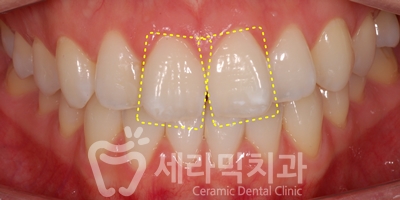 앞니 돌출, 나비치아를 남몰래 해결한 치아교정 전후! 관련 이미지 13