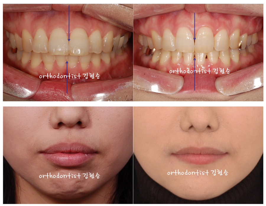 세라믹교정 세라믹치과-돌출입발치교정 10 관련 이미지 7