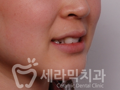 덧니 세라믹교정 전후사진, 학동역 세라믹치과 관련 이미지 4