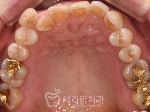 40대에 이어 50대 치아교정 전후사례 증가 추세 관련 이미지 8