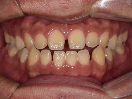 치아가 반대로 물리는 관련 이미지 8