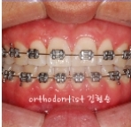 세라믹교정, 모르겠다면 이곳을 클릭 관련 이미지 2